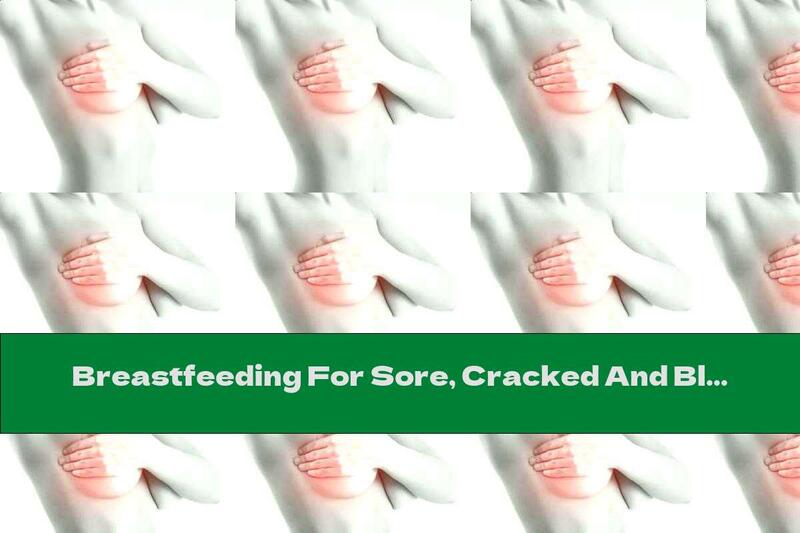 Breastfeeding For Sore, Cracked And Bleeding Nipples