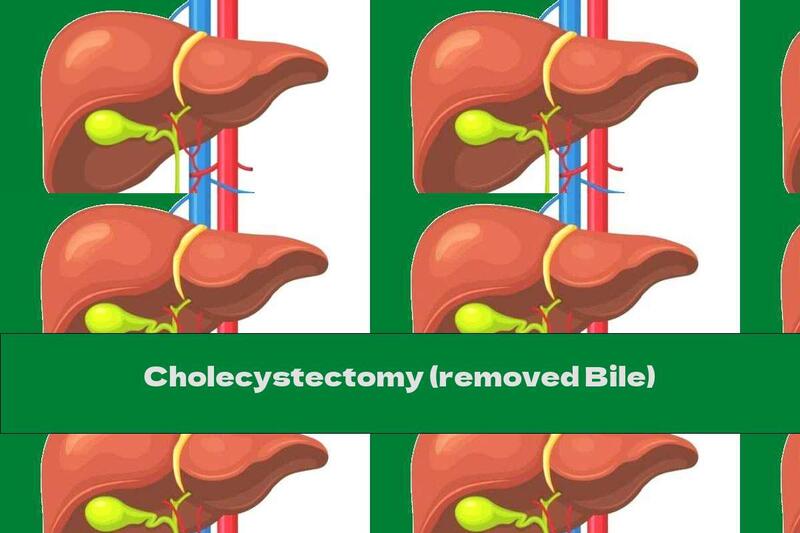 Cholecystectomy (removed Bile)
