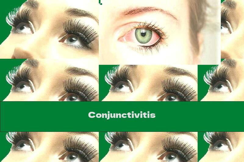 Conjunctivitis
