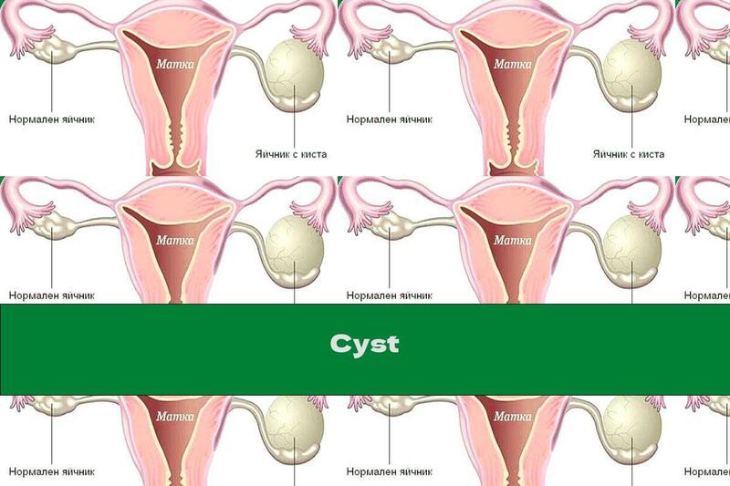 Cyst