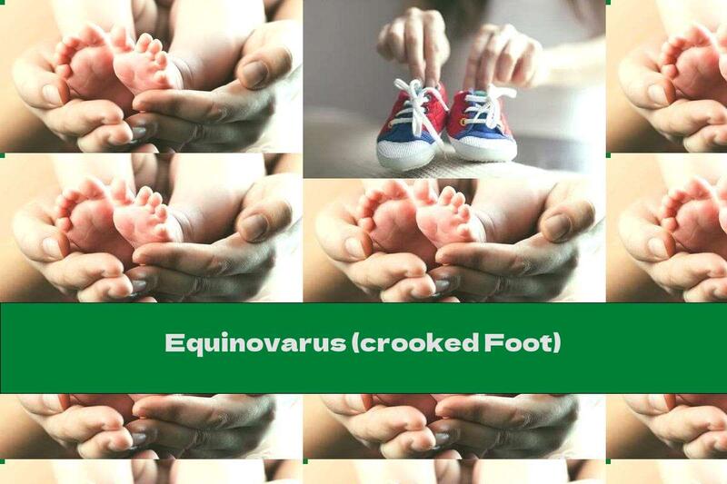 Equinovarus (crooked Foot)