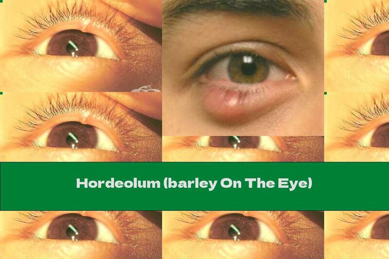Hordeolum (barley On The Eye)
