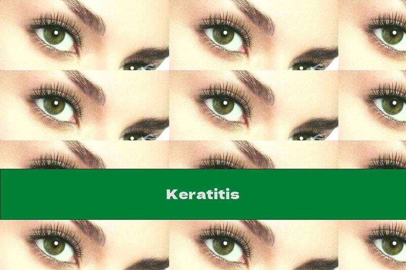 Keratitis