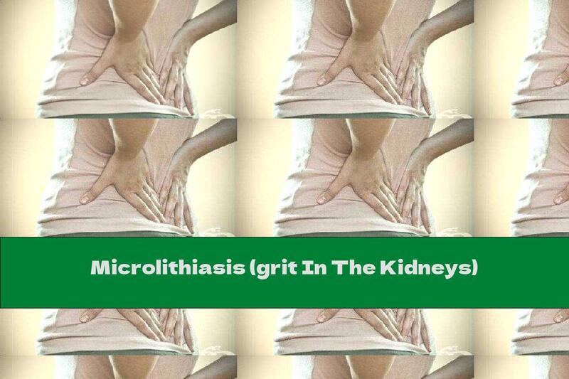 Microlithiasis (grit In The Kidneys)