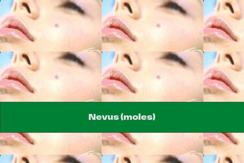 Nevus (moles)