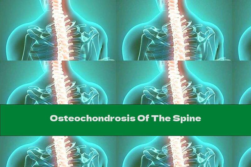 Osteochondrosis Of The Spine