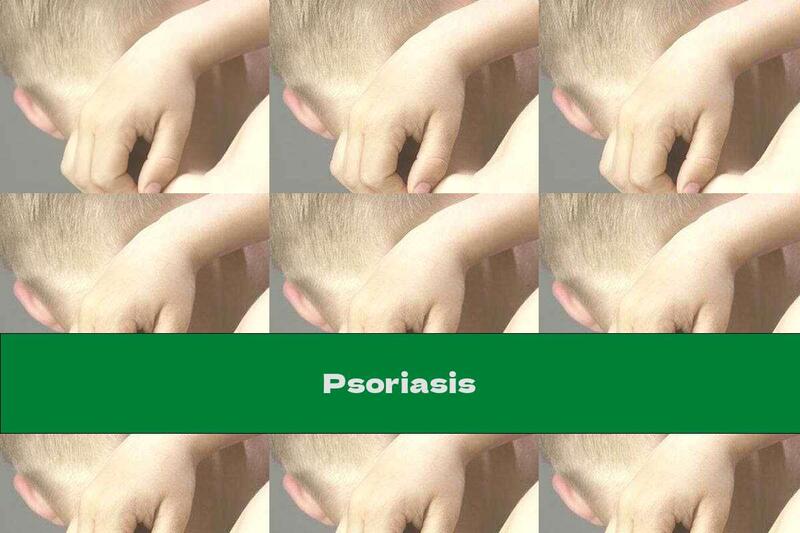 Psoriasis