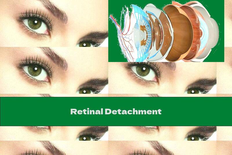 Retinal Detachment
