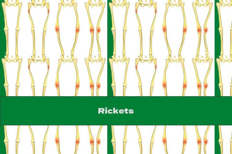 Rickets