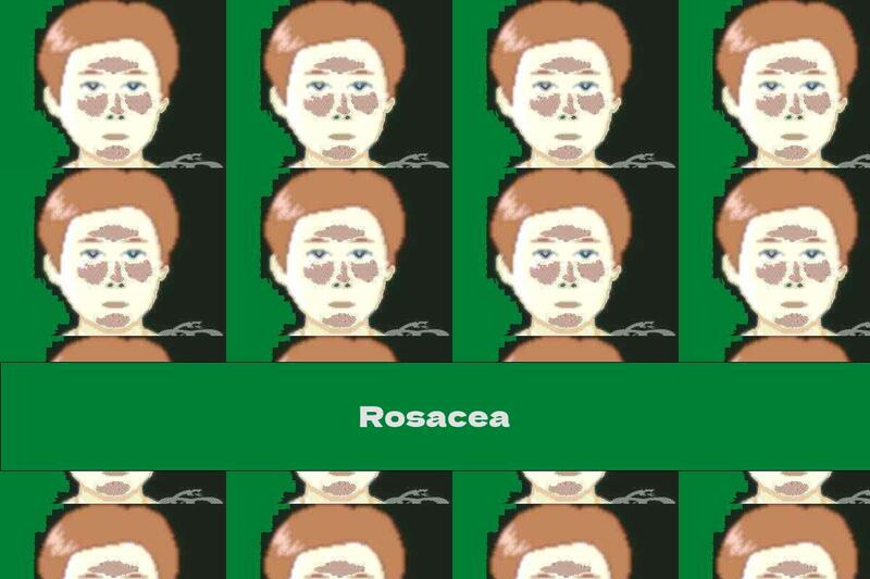 Rosacea